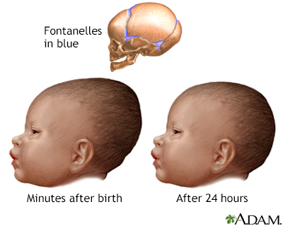 Newborn head molding