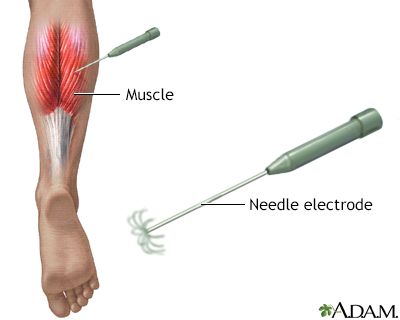 Electromyography