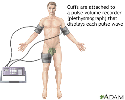 Plethysmography