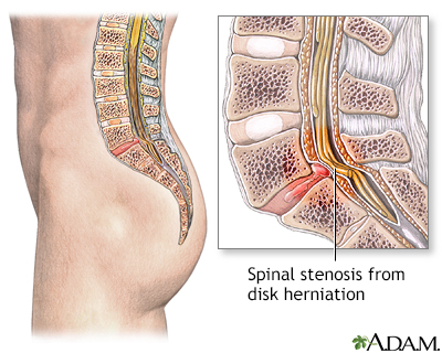 Spinal stenosis