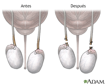 Antes y después de la vasectomía