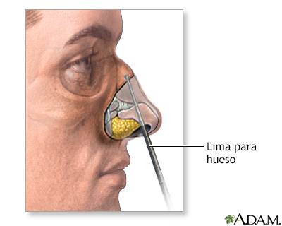 Procedimiento