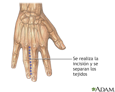 Incisión