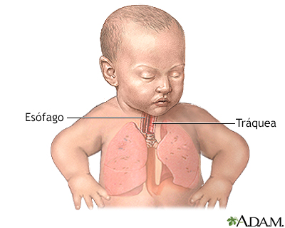 Reparación quirúrgica de una fístula traqueosofágica - serie