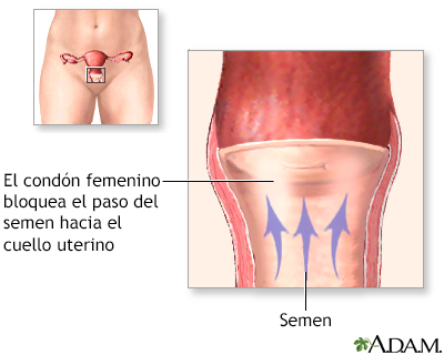 Condón femenino