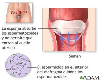 Esponja anticonceptiva