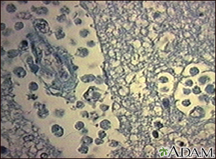 Absceso cerebral amebiano