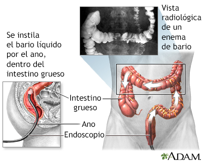 Enema de bario