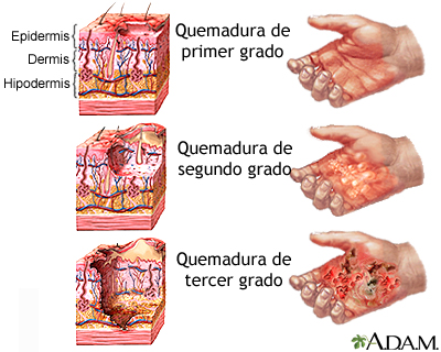 Quemaduras