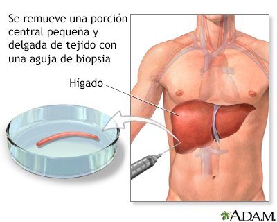 Biopsia de hígado