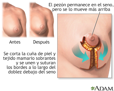 Mamoplastia