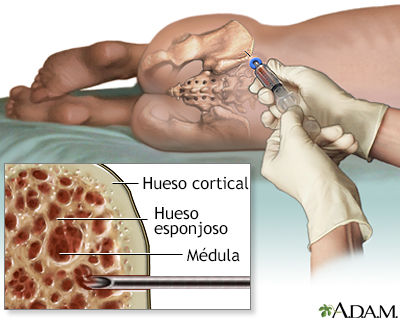 Aspiración de médula ósea