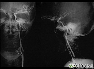 Estenosis carotídea - radiografía de la arteria izquierda