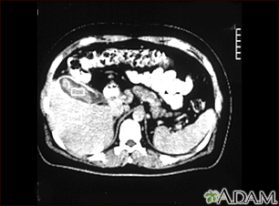 Tomografía computarizada de una colecistitis