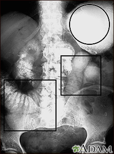 Ileo - Radiografía del estómago e intestino distendido