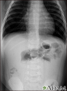 Radiografía de una invaginación