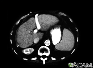 Cirrosis hepatica - TC