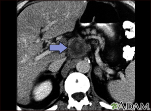 Cáncer pancreático, TC