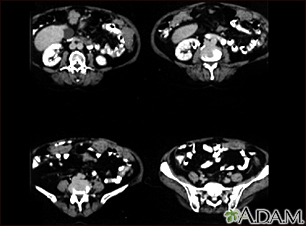 TC de cáncer peritoneal y de ovario