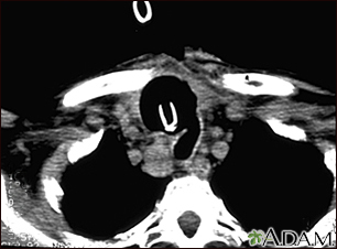 Tomografía computarizada de cáncer de tiroides