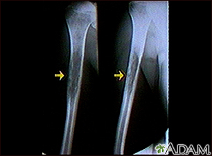 Rayos X - un sarcoma de Ewing