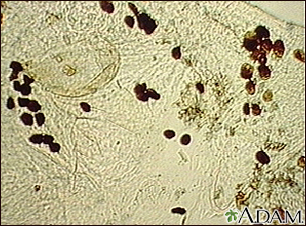 Microfotografía de las heces del  ácaro de la escabiosis