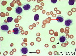 Leucemia de células pilosas - vista microscópica