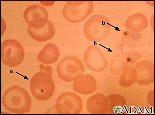 Malaria, fotomicrografía de parásitos celulares