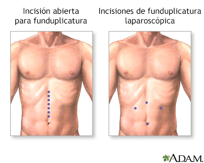 Incisión