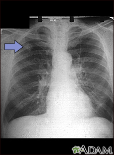 Adenocarcinoma - placa de rayos x de tórax