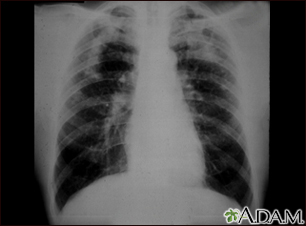 Neumoconiosis complicada del minero