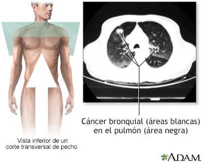 TC de cáncer bronquial