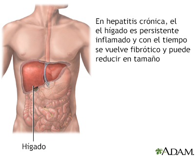 Hepatitis crónica