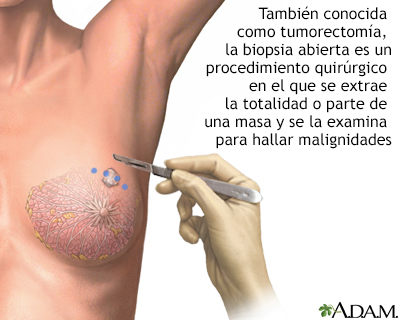 Biopsia abierta del seno