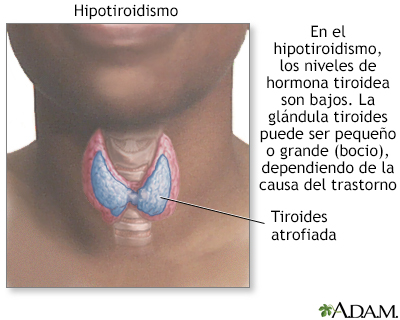 Hipotiroidismo