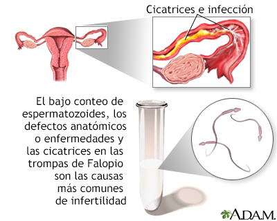  Factores de infertilidad 