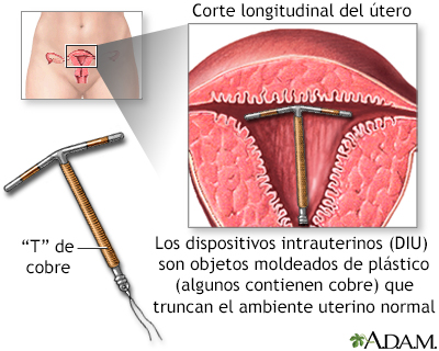 Dispositivos intrauterinos