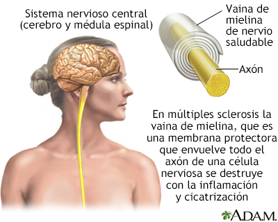 Esclerosis múltiple