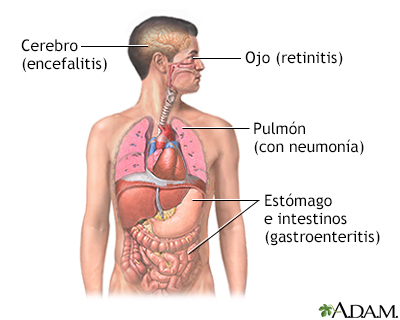 CMV (citomegalovirus)