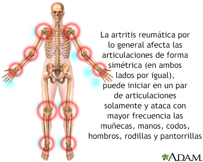 Artritis reumatoide