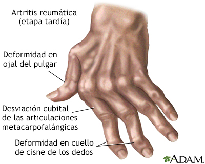 Artritis reumatoide