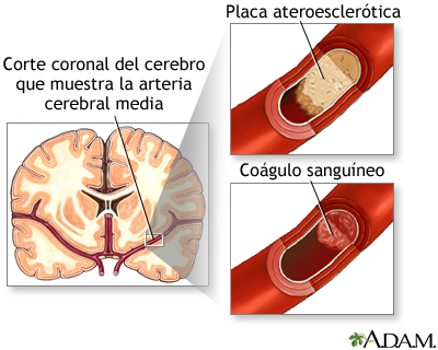 Embolia