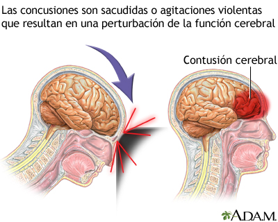 Concusión