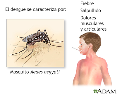 Fiebre por dengue