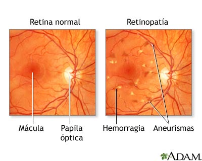 Retinopatía diabética