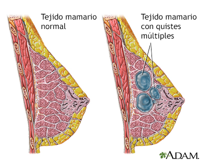 Cambio fibroquístico de la mama