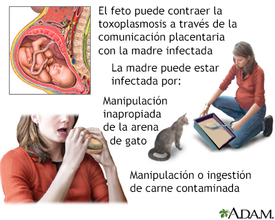 Toxoplasmosis