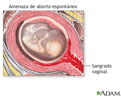 Amenaza de aborto espontáneo