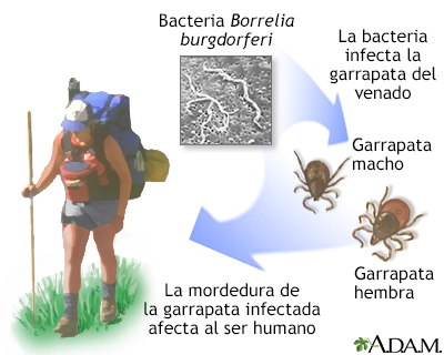 Enfermedad de Lyme