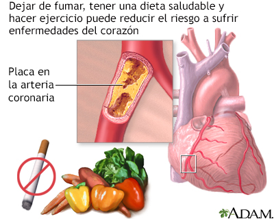 Prevención de la enfermedad cardíaca